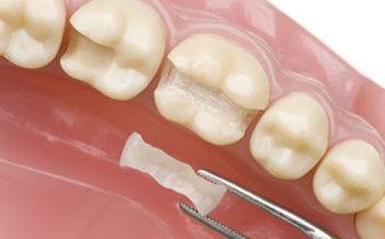 gaatjes in en vullen - Tandarts Dental Clinic